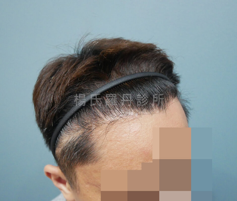 M型禿 植髮