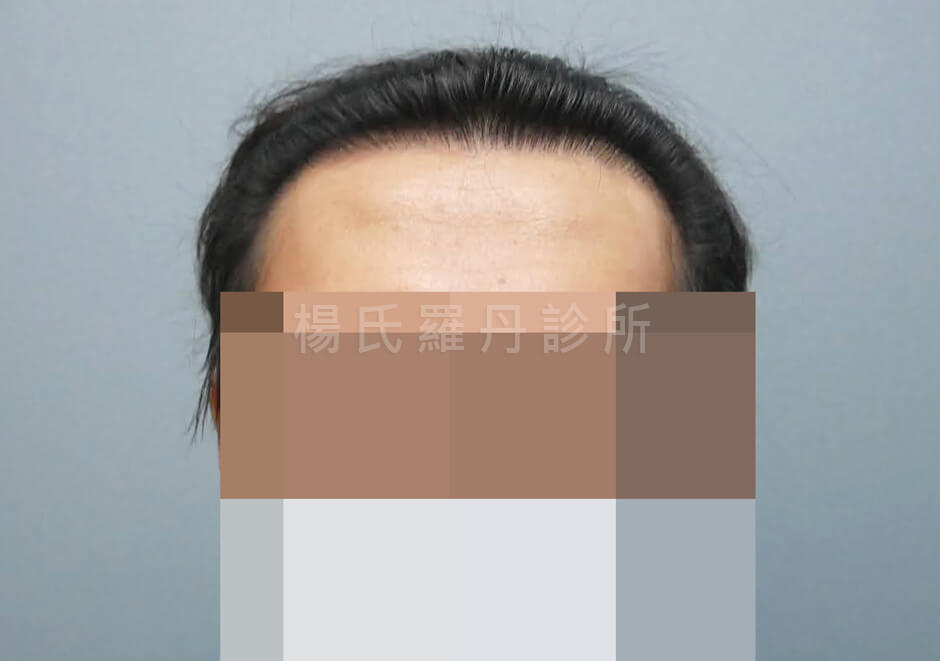 植髮 髮際線