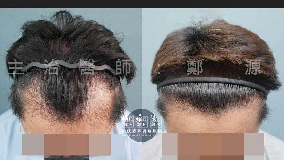 植髮 M型禿 植髮成果