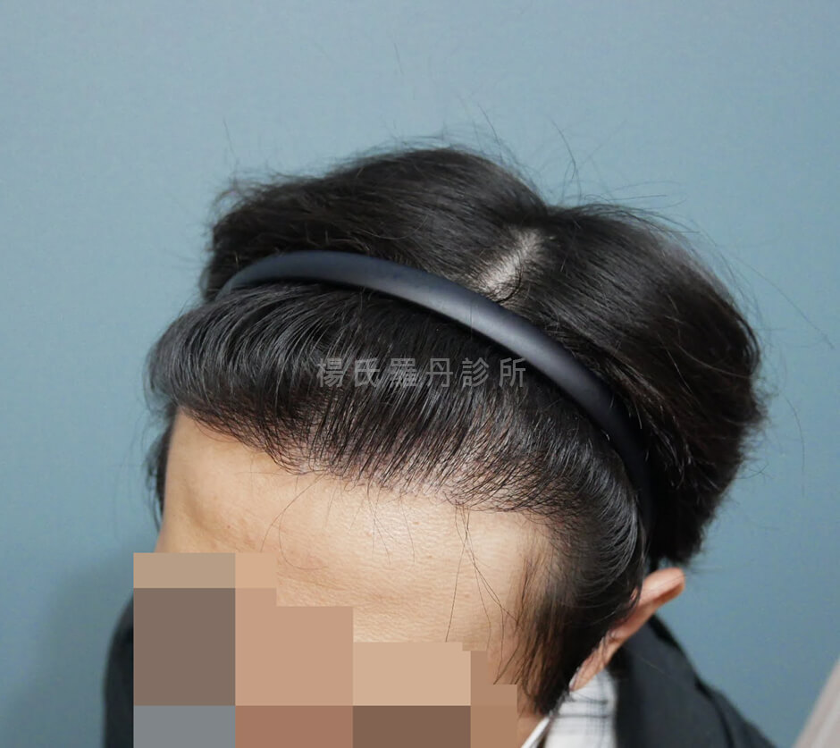 植髮 植髮成果