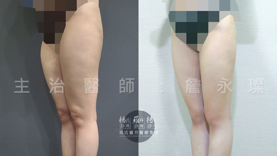 大腿抽脂 抽脂 雷射減脂