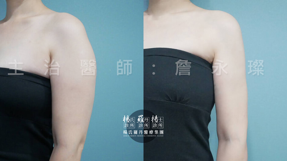手臂抽脂 雷射減脂 抽脂