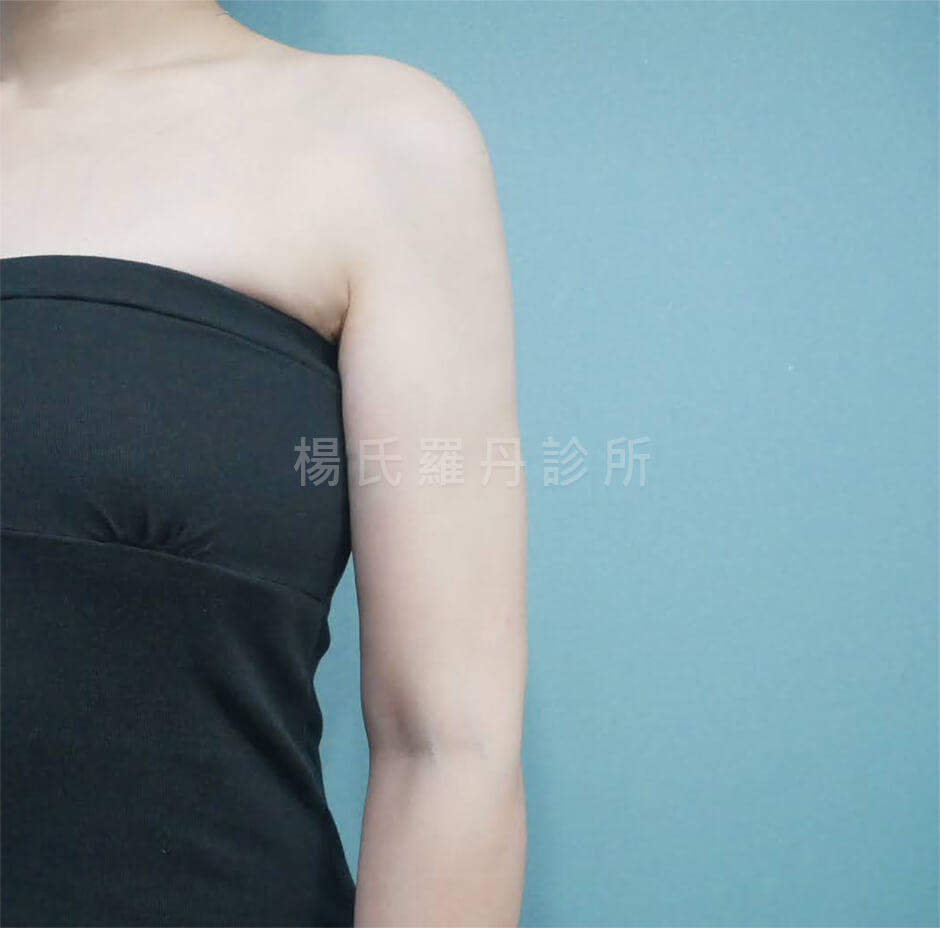 抽脂 手臂抽脂