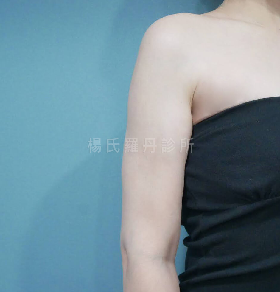 減脂手術 減脂 瘦手臂