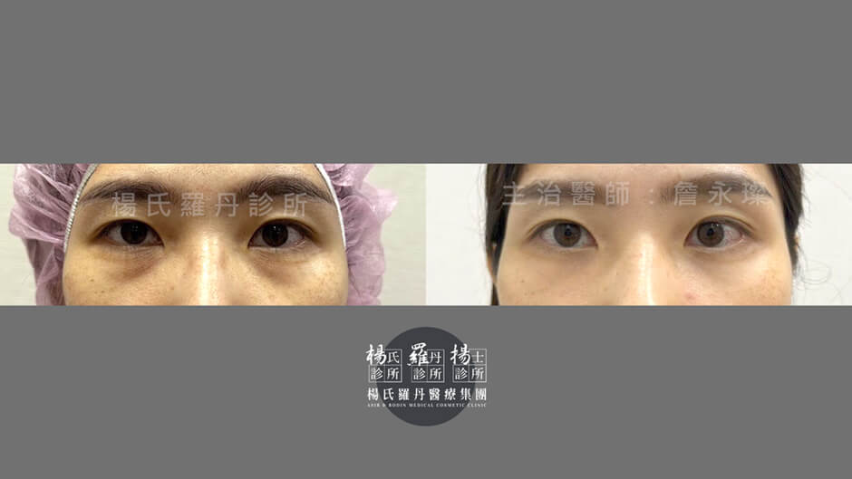 眼袋 眼袋消除 除眼袋 黑眼圈