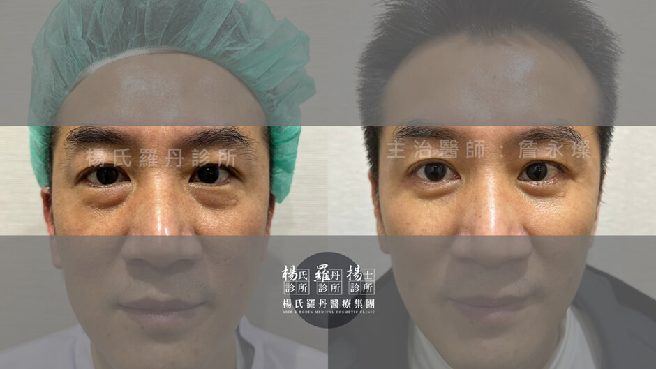 眼袋 除眼袋 眼袋消除