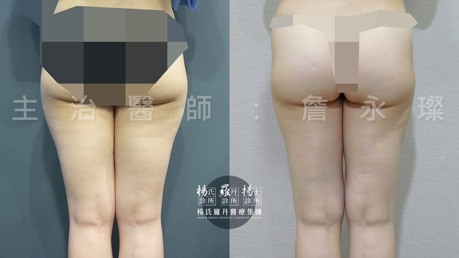 大腿環抽 雷射減脂 減脂手術