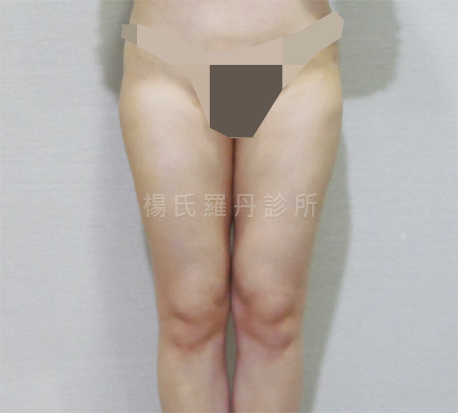 大腿抽脂 雷射減脂 瘦大腿