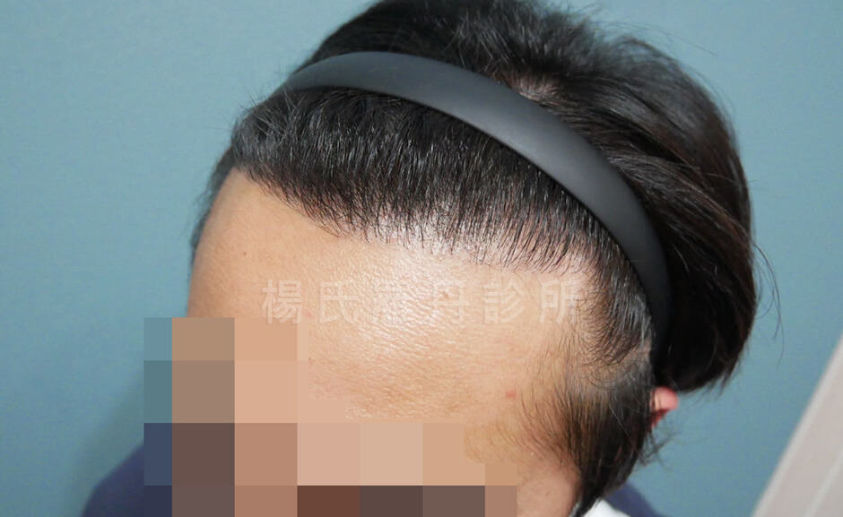 植髮成果 植髮