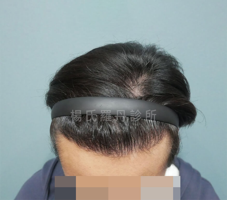 植髮 植髮成果