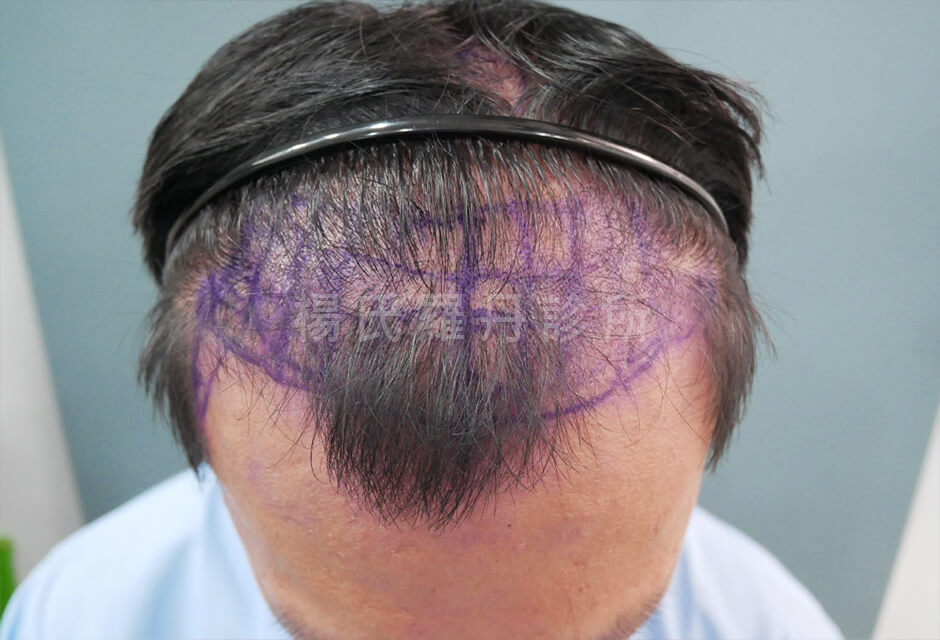 植髮 植髮成果