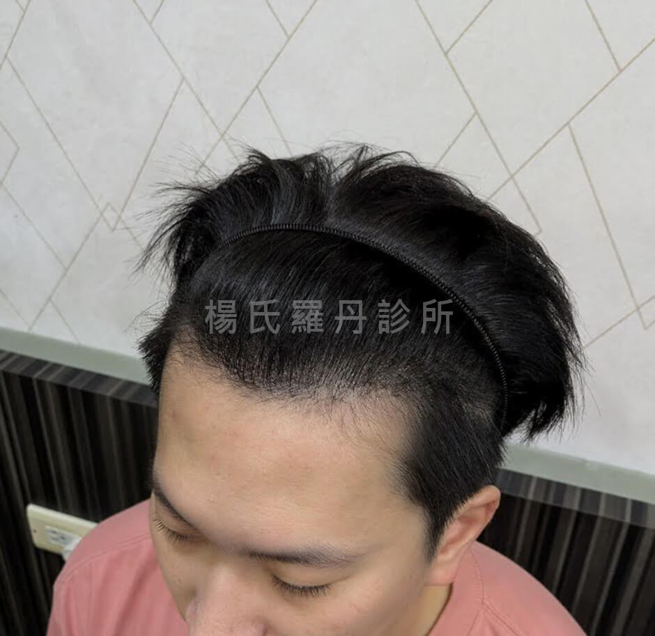 髮際線 植髮手術