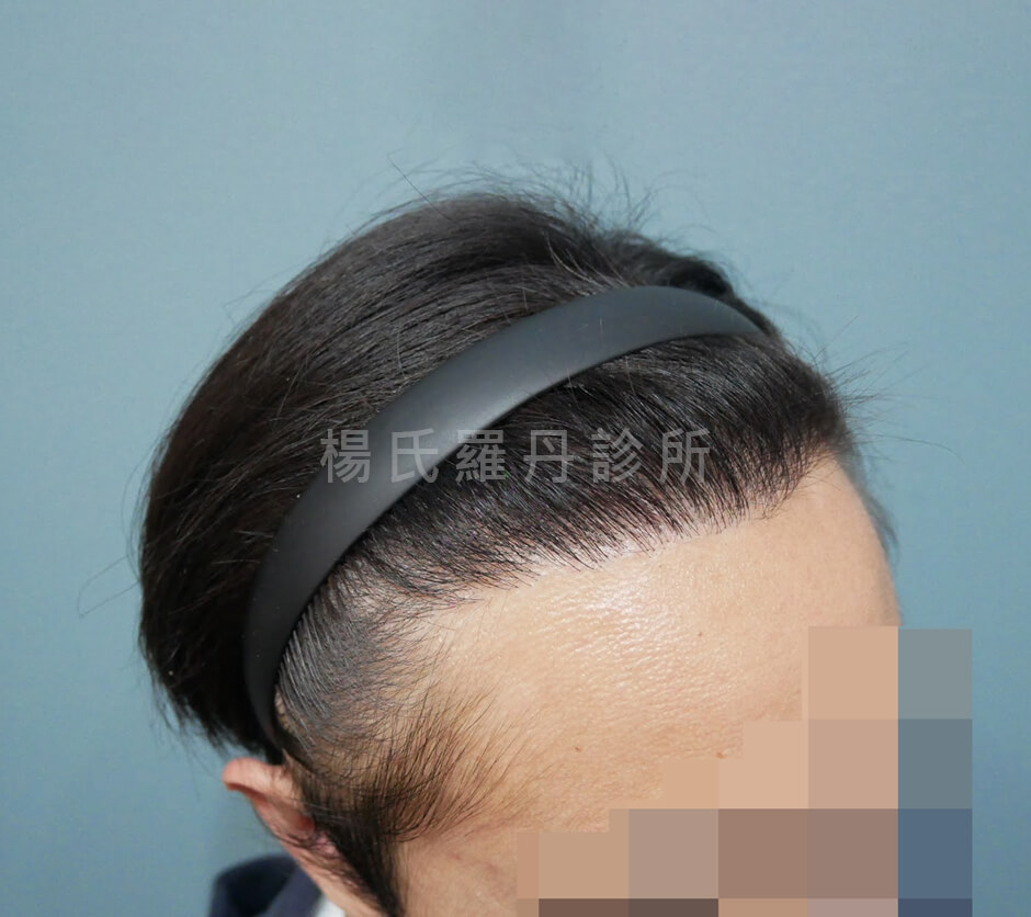 植髮 植髮手術