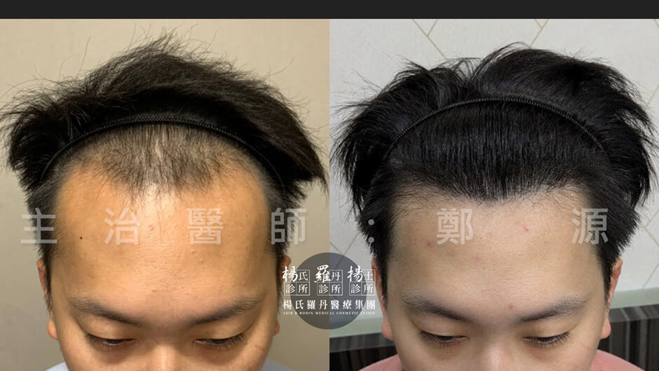 植髮 植髮成果 植髮手術