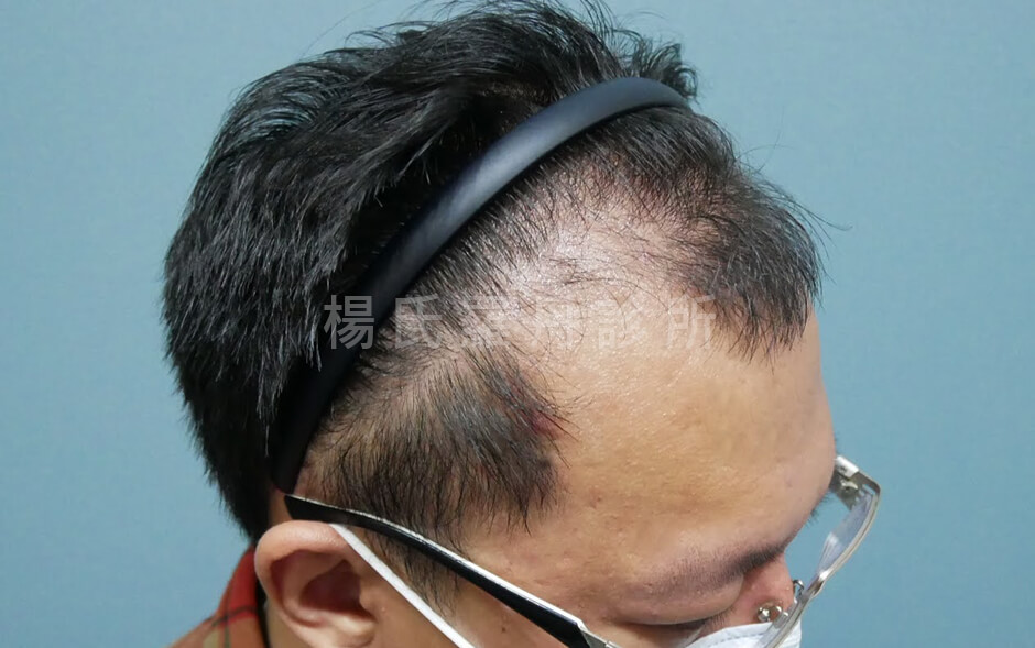 植髮 禿頭
