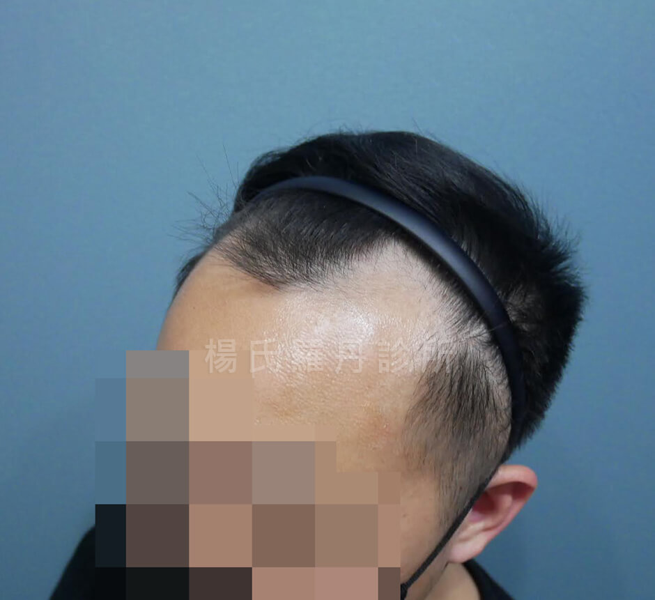 植髮 髮際線植髮