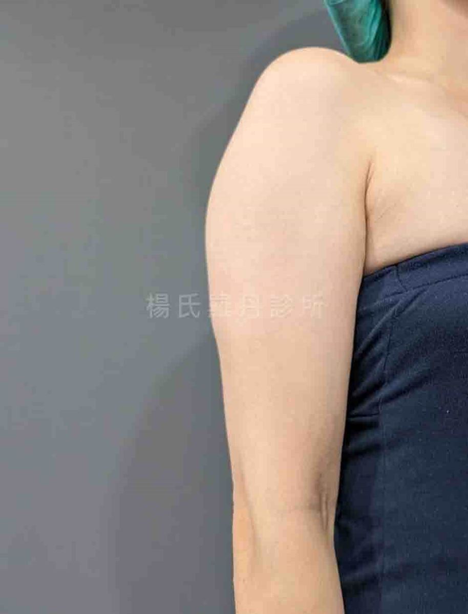 手臂抽脂 抽脂