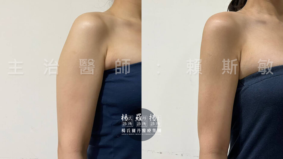 手臂抽脂 抽脂 雷射減脂