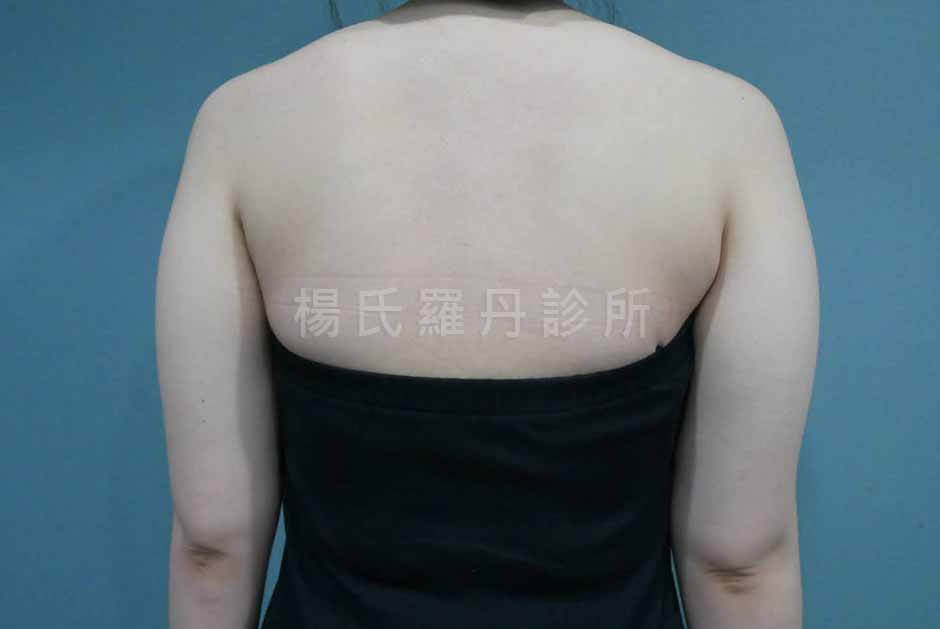 雷射減脂 掰掰袖