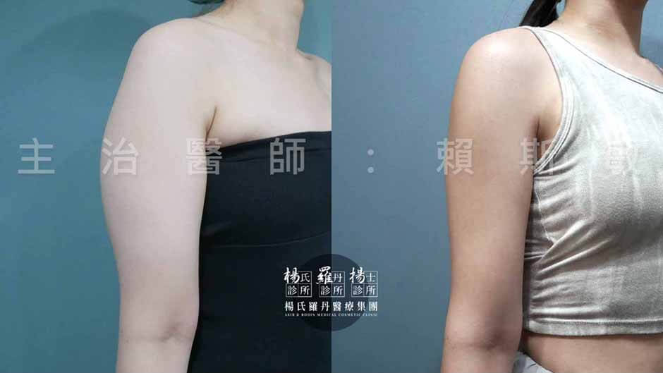 手臂抽脂 雷射減脂 抽脂