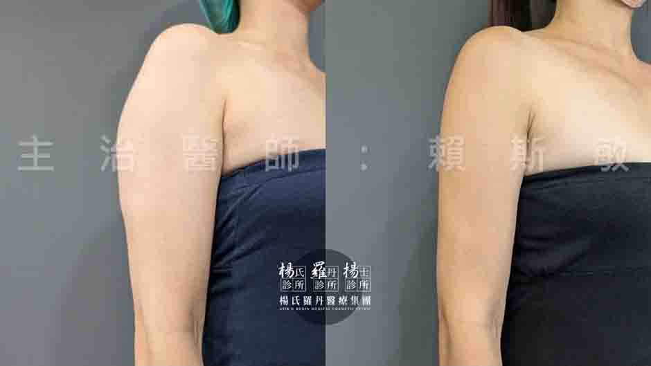 手臂抽脂 抽脂 雷射減脂