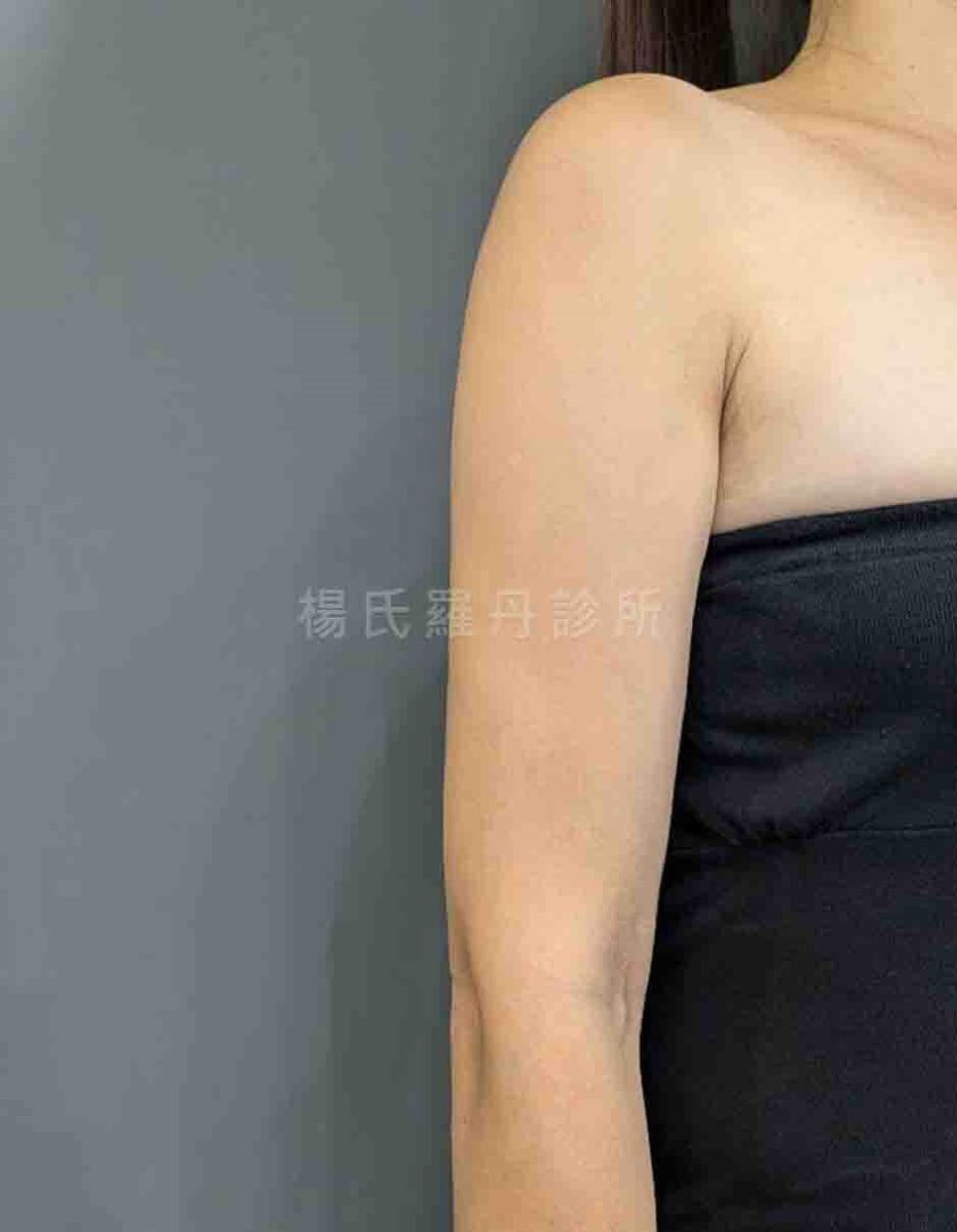抽脂 手臂抽脂