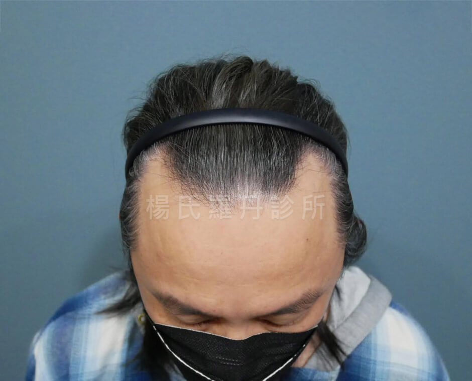 植髮 禿頭