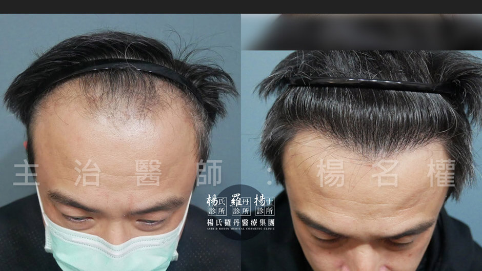 植髮 植髮成果 楊氏羅丹