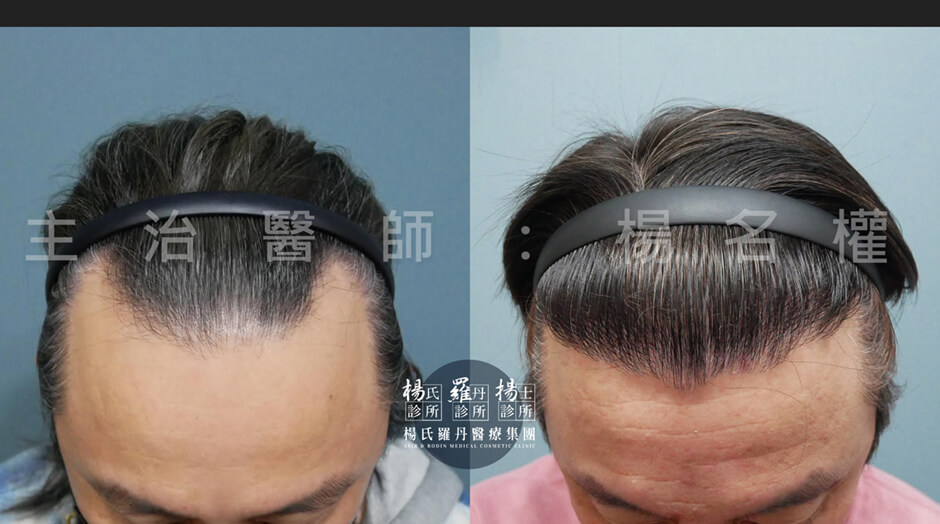 植髮 髮際線植髮 植髮成果