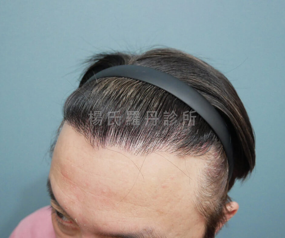 植髮成果 植髮