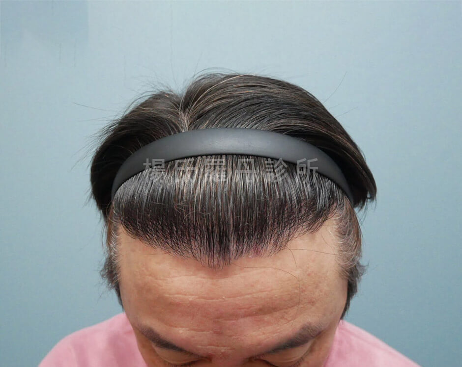 植髮 植髮成果
