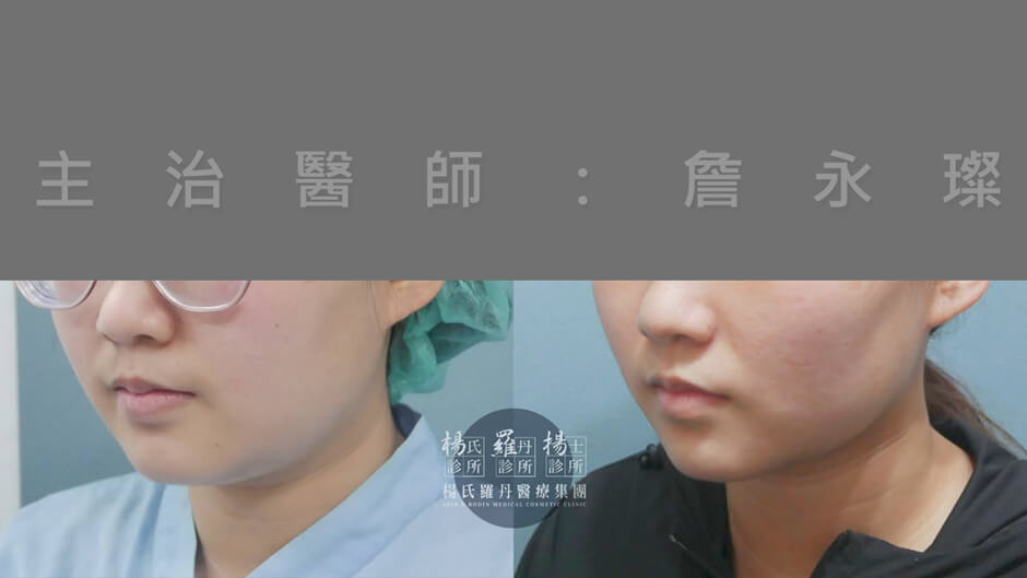 下巴抽脂 抽脂 雷射減脂