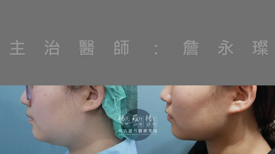 下巴抽脂 雷射減脂 抽脂