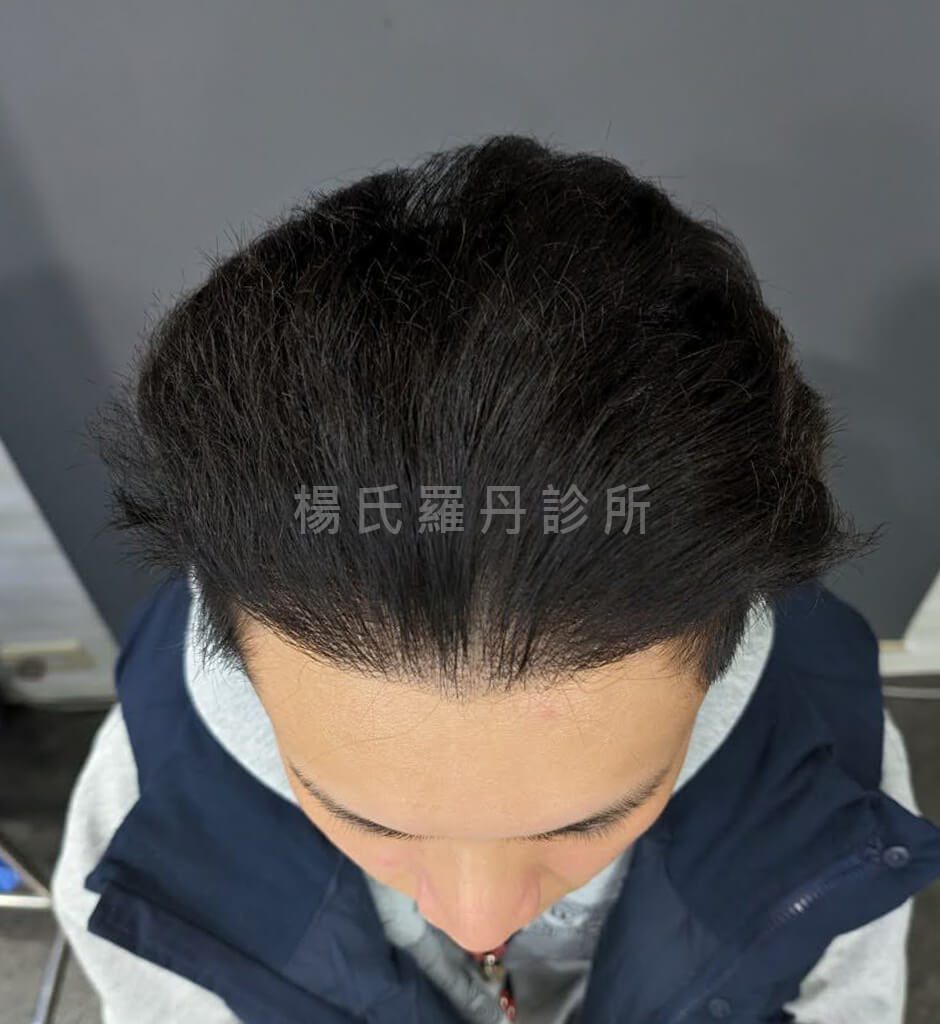 植髮 植髮成果
