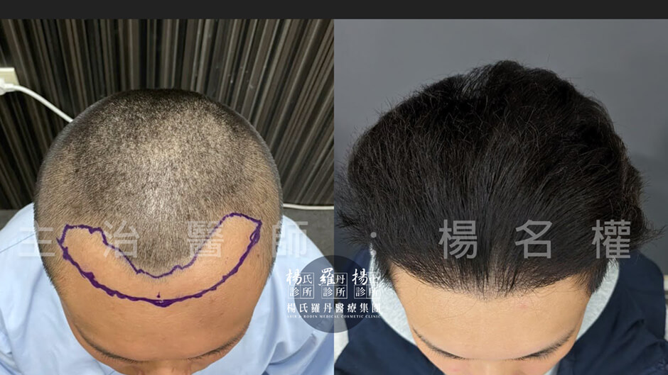 植髮 植髮成果 美型植髮