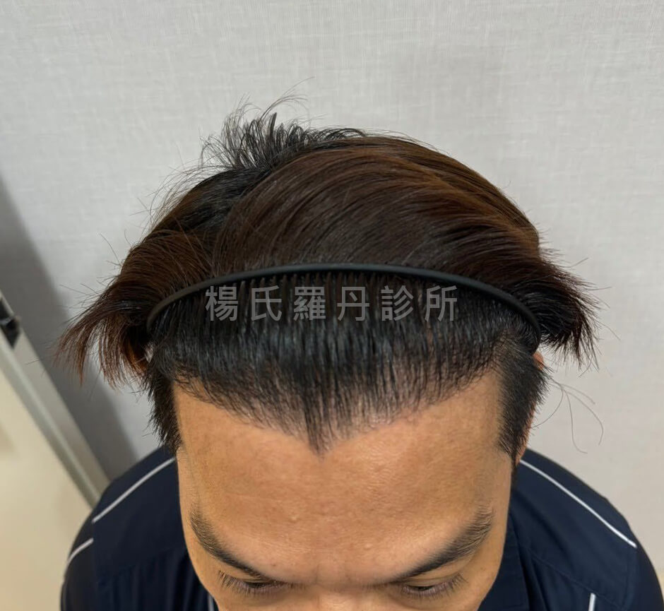 植髮 髮際線