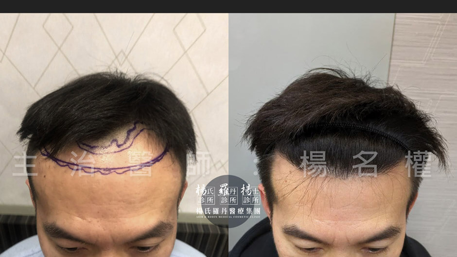 植髮 植髮效果 雄性禿