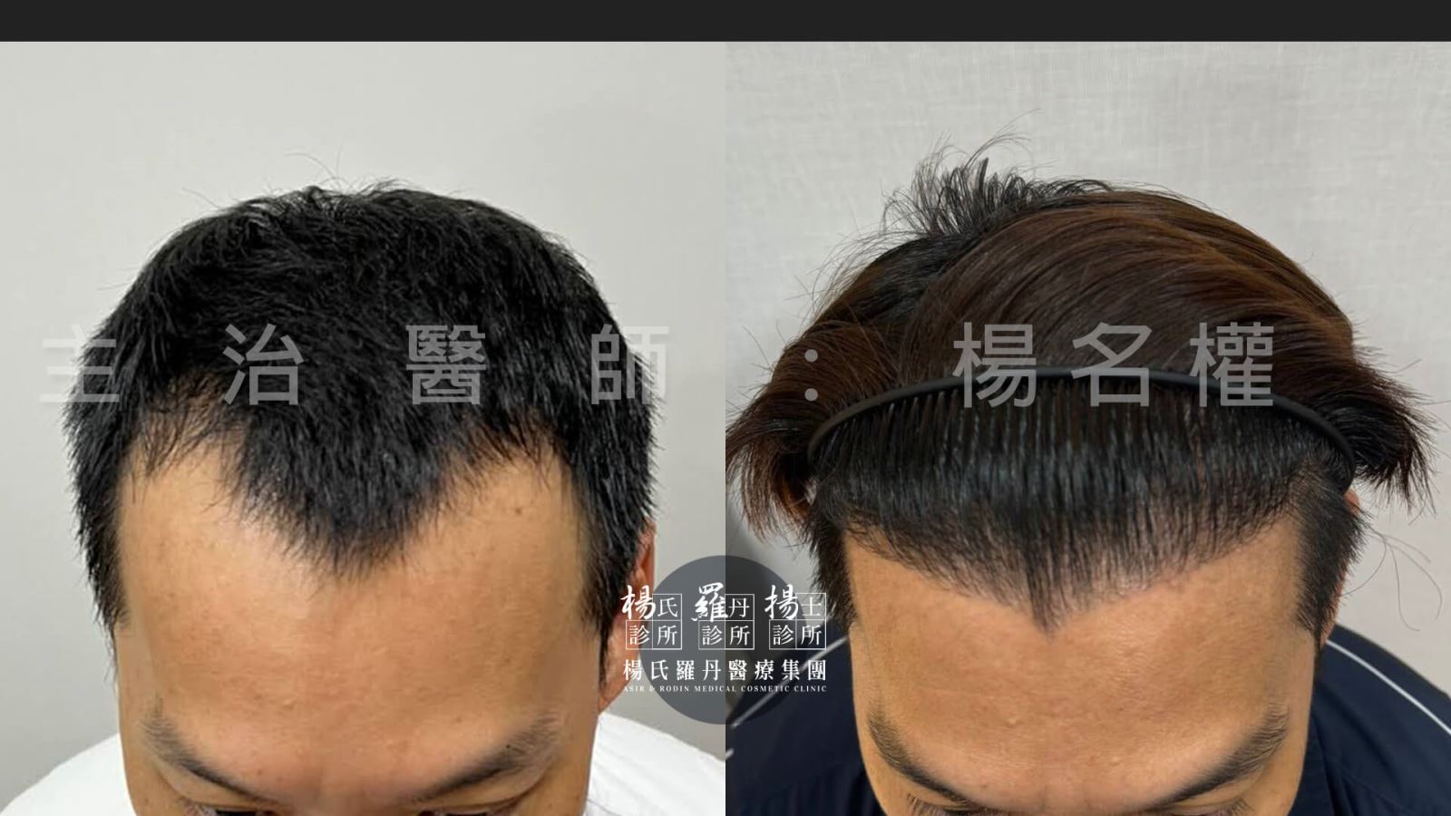 植髮 植髮效果 髮際線植髮