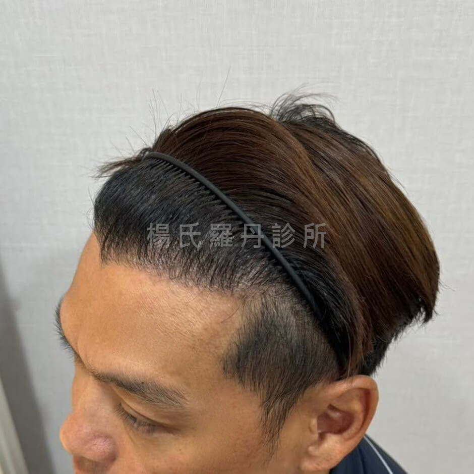 植髮 禿頭