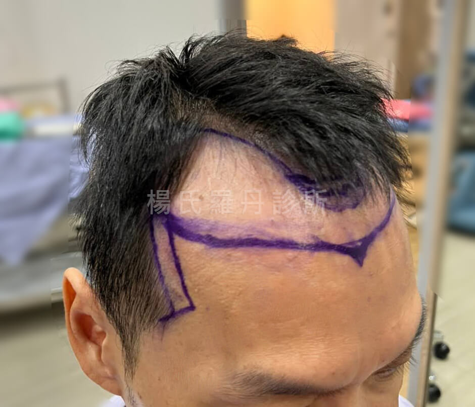 禿頭 植髮