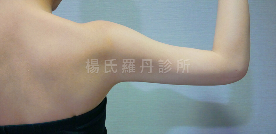 雷射減脂 手臂抽脂
