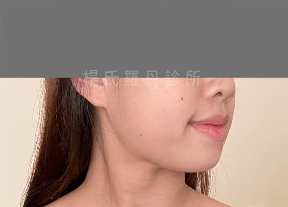 減脂手術 雷射減脂 瘦下巴