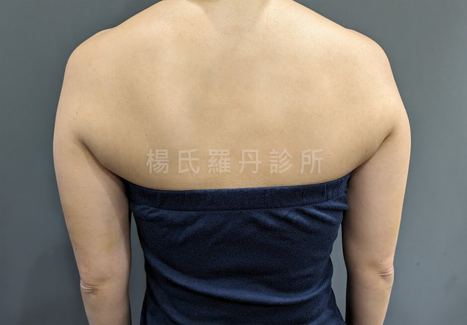 減脂手術 瘦手臂