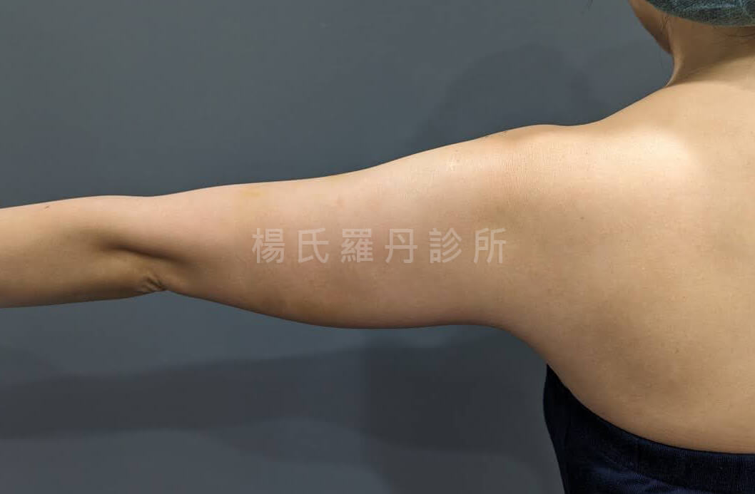 手臂抽脂 雷射減脂