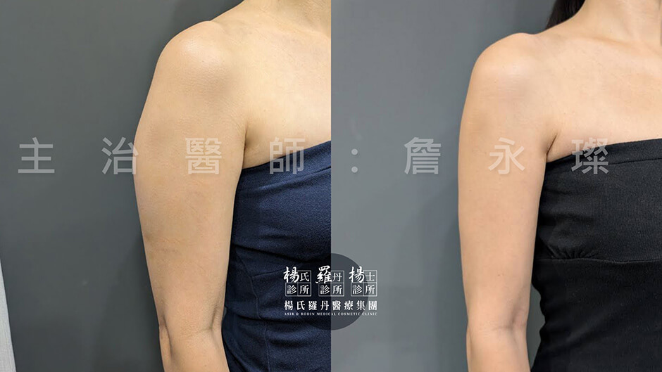 手臂抽脂 雷射減脂 抽脂
