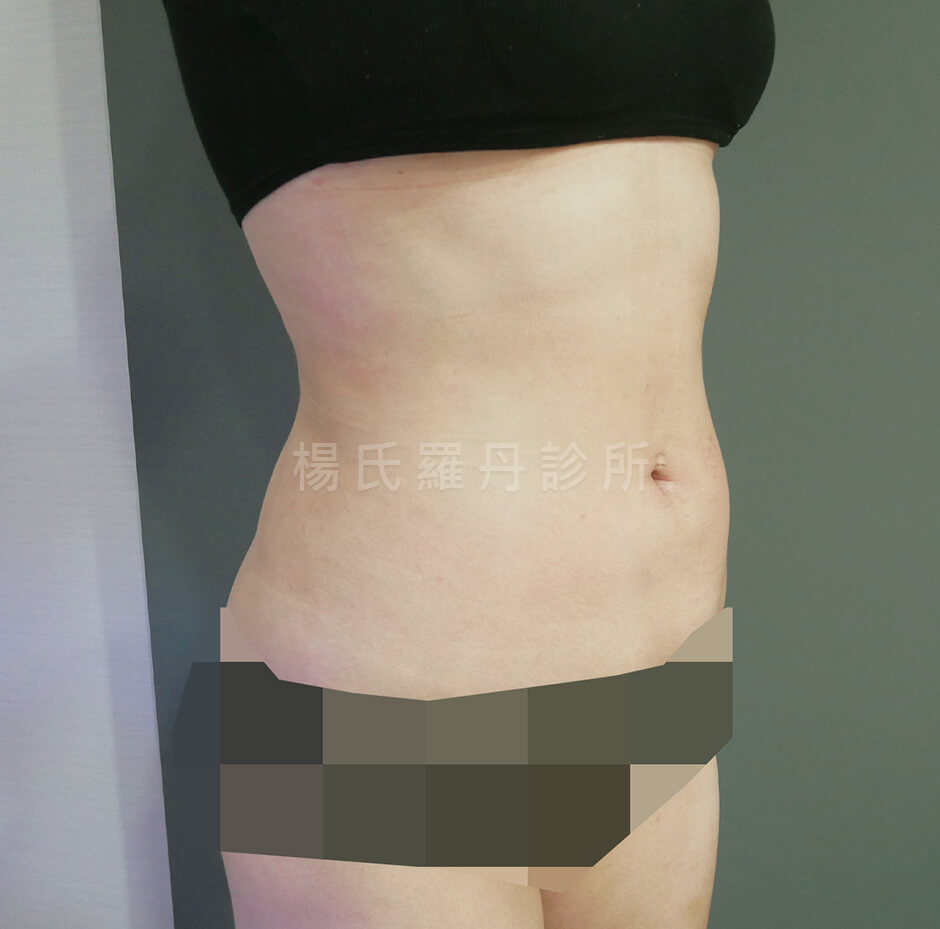抽脂 腹部環抽
