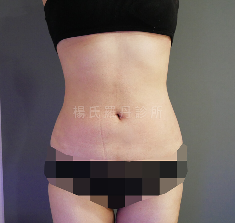 減脂手術 雷射減脂 瘦肚子