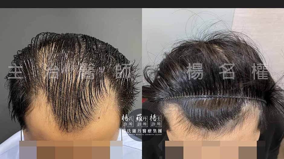 植髮 微創植髮 植髮手術