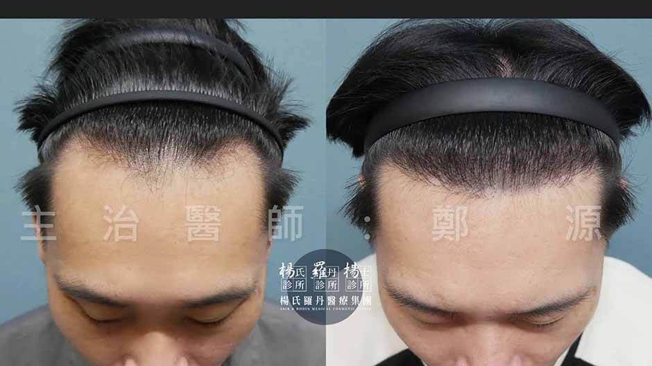 植髮 植髮效果 髮際線