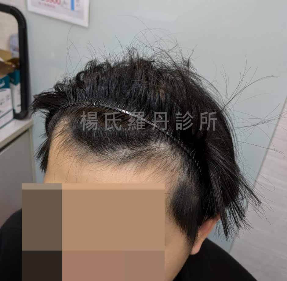 植髮手術 植髮